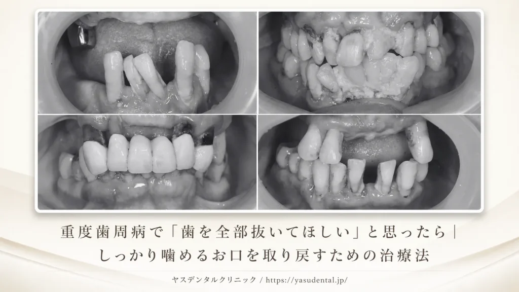 重度歯周病で「歯を全部抜いてほしい」と思ったら｜しっかり噛めるお口を取り戻すための治療法