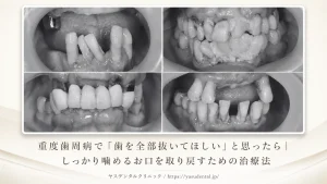 重度歯周病で「歯を全部抜いてほしい」と思ったら｜しっかり噛めるお口を取り戻すための治療法